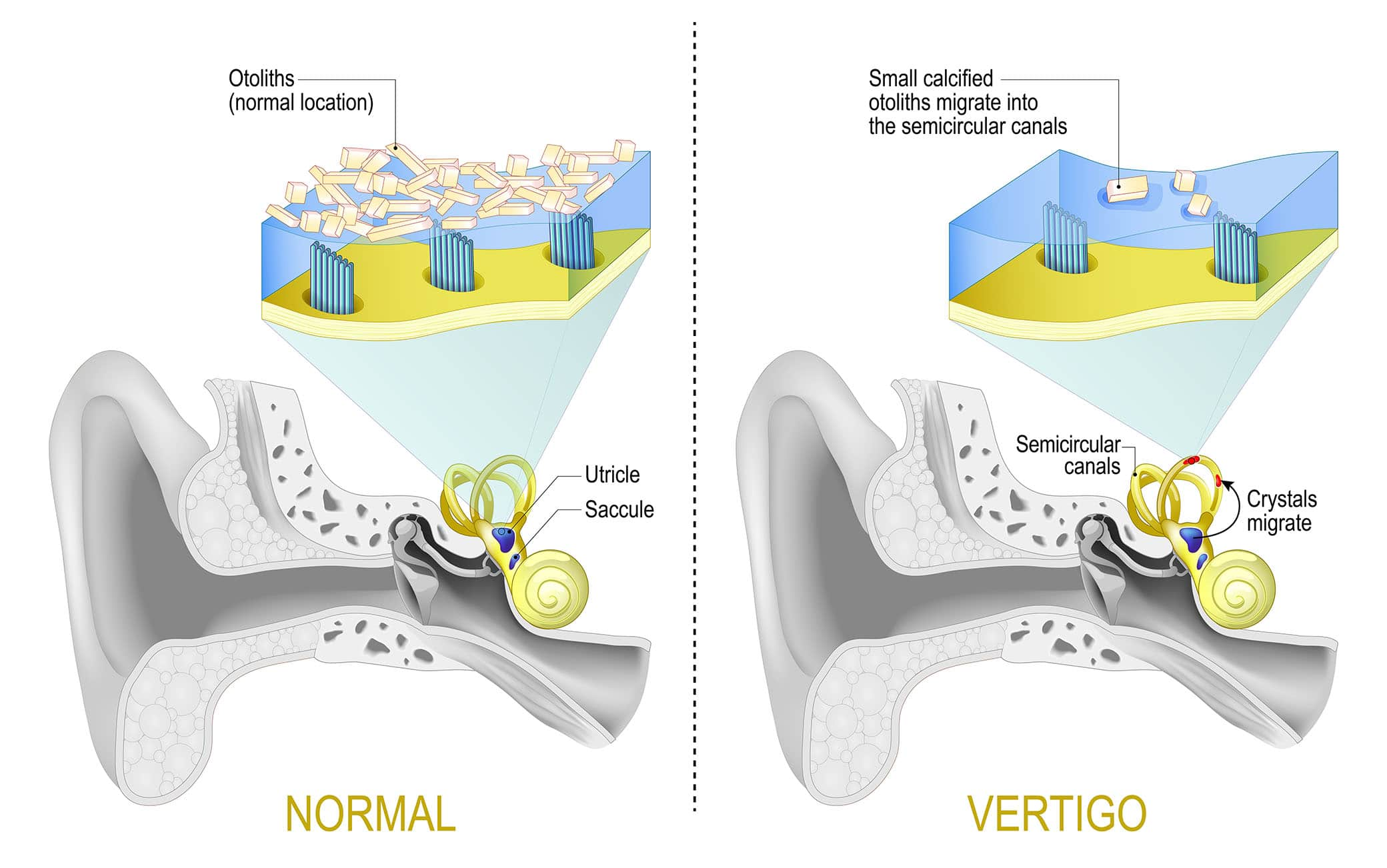 Benign paroxysmal positional vertigo. BPPV. labyrinth of the inner ear with Semicircular canals. Comparison between Normal vestibular system and Vertigo when Small calcified otoliths migrate from Saccule and Utricle into the semicircular canals. Vector illustration